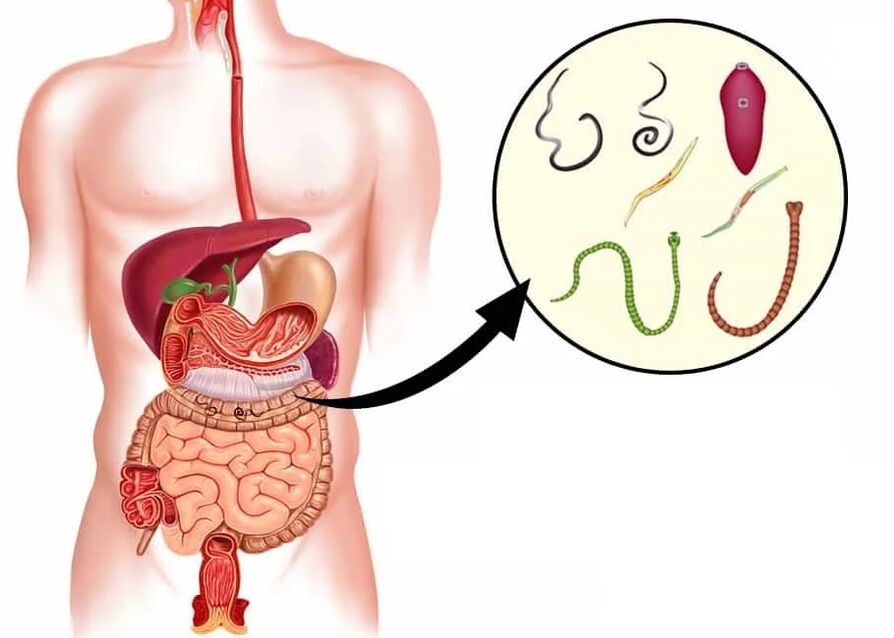 Vermixin hilft bei den meisten Arten von Helminthen