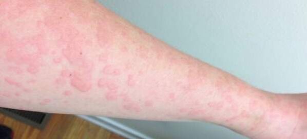 Hautallergien sind ein Zeichen für das Vorhandensein von Parasiten im Körper
